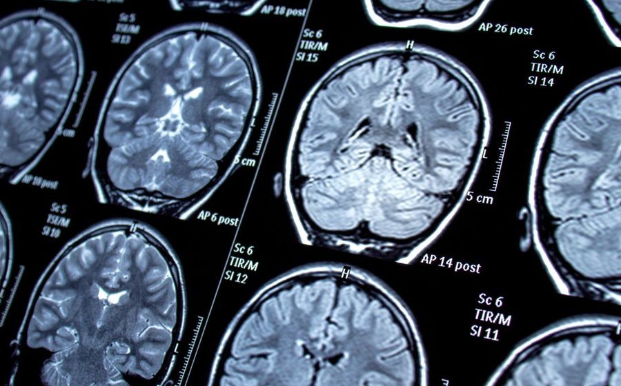 Neurosurgery